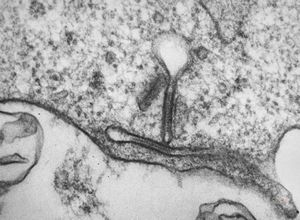 M,1y. | Birbeck granules (X-granules) - skin, histiocytosis X M,1y. | Birbeck granules (X-granules) - skin, histiocytosis X